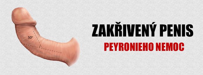 Zakřivení penisu | Peyronieho choroba - Možné příčiny, příznaky a léčba