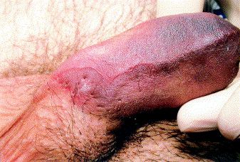 Ukázka zlomeniny penisu